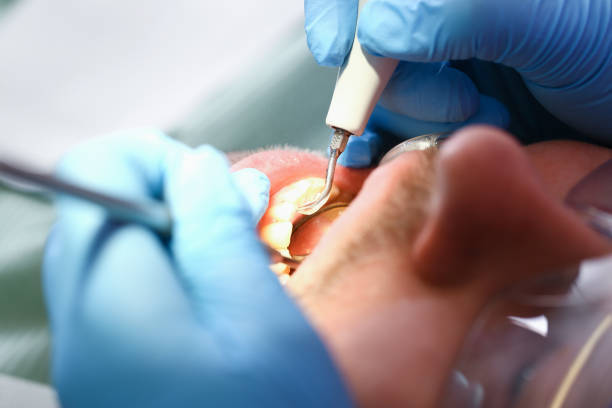 Best Emergency Root Canal Treatment in Camp Wood, TX