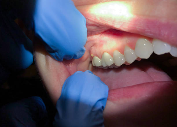Best Emergency Dentist for Knocked-Out Tooth in Camp Wood, TX